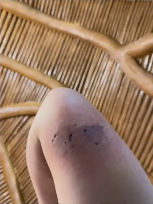 伤口触目惊心！男子住野生动物园酒店被小熊猫进屋咬伤根本来不及躲！园区回应(图2)